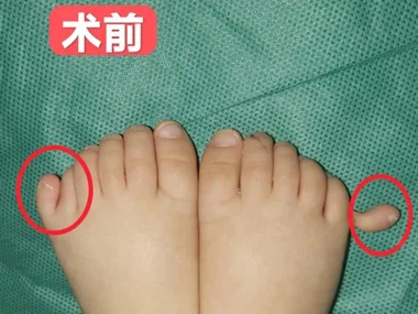 발가락이 많은 아기를 위한 신발을 선택하는 것은 너무 어렵습니다! 수술 후 자유롭게 신발을 신는 그 안도감은 엄마만이 알 수 있는 것입니다.