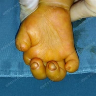 굴곡 구축 수술