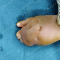 스페이드 손 분리 수술